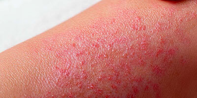 Dettaglio Crema Pelle a Tendenza Atopica