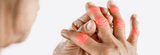 How Is Rheumatoid Arthritis Different From Other Arthritis