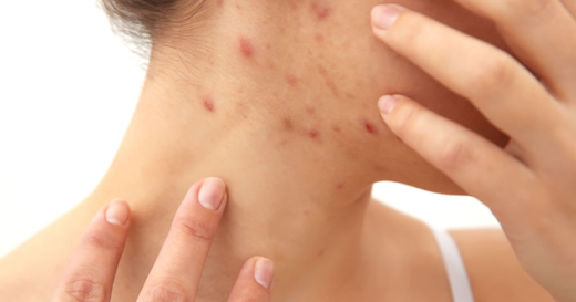 How Long Do Scabies Live on Surfaces? What You Need to Know