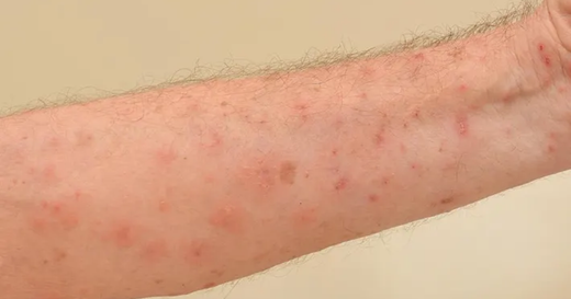 How to Treat Scabies at Home - A Natural, Step-by-Step Guide