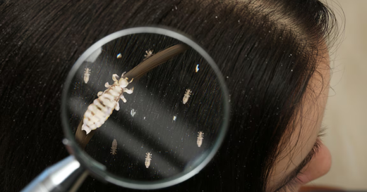 Does Lice Shampoo Really Kill Eggs And Lice Completely? The Honest Answer