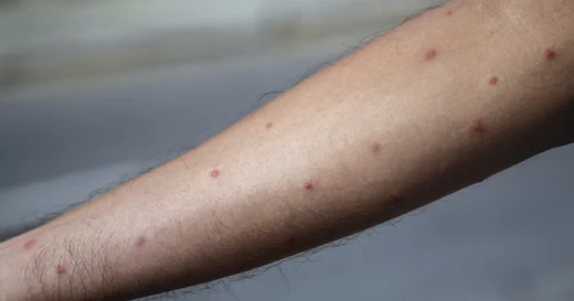 How To Treat Mite Bites On Skin Naturally - Relief That Actually Works