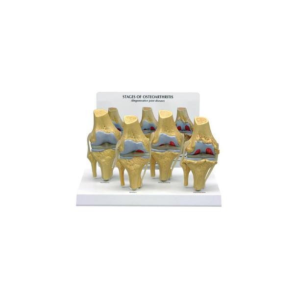 GPI Anatomicals 4-Stage Osteoarthritis Knee Model