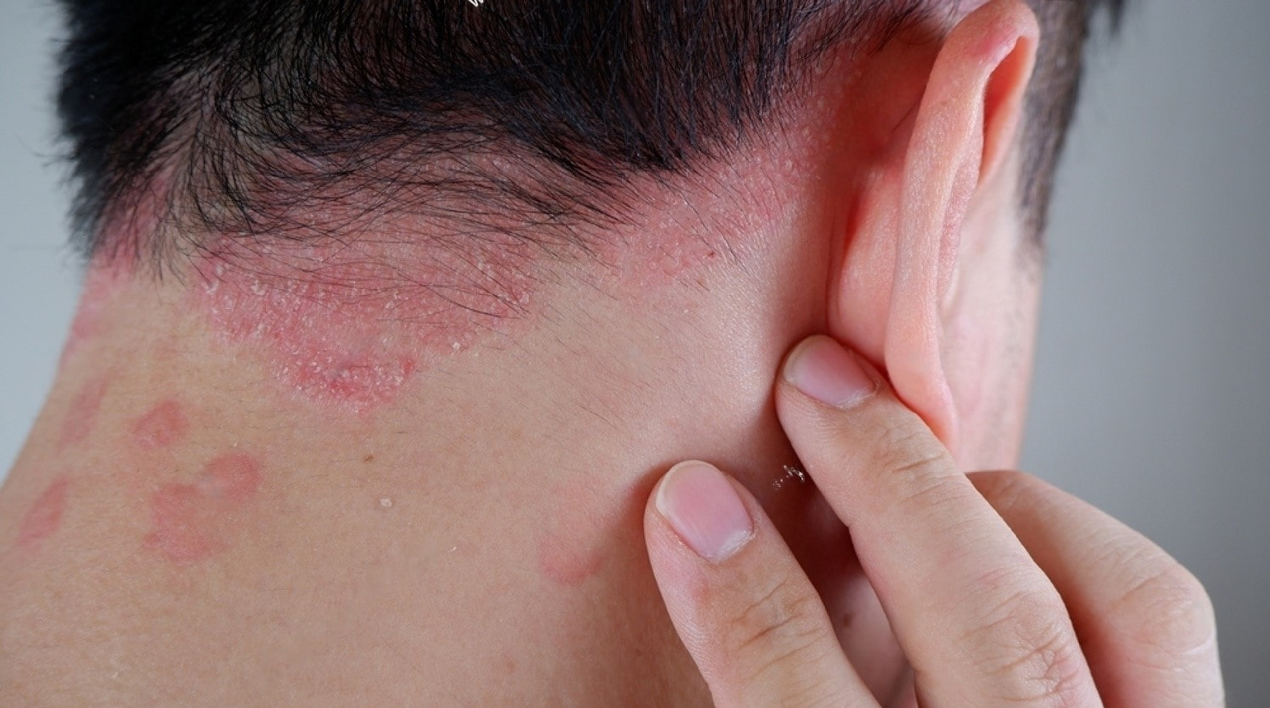 What Condition is Causing Your Itchy Scalp? DermaZinc®