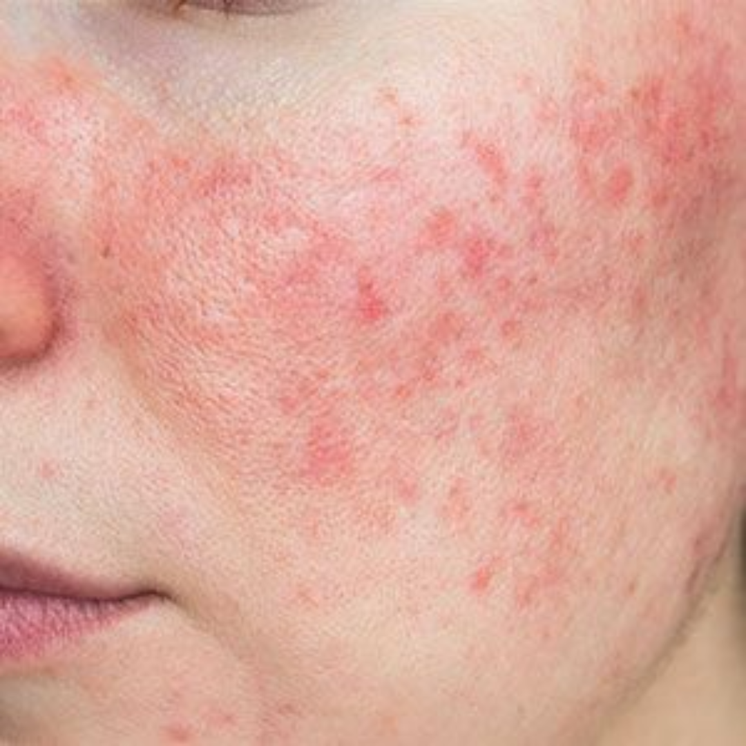 Sensitivity & Redness