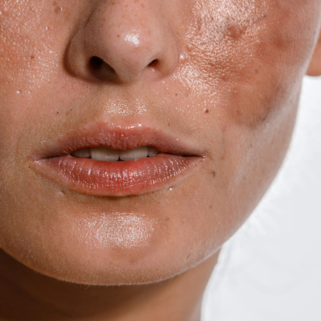 Hyperpigmentation & Uneven Tone