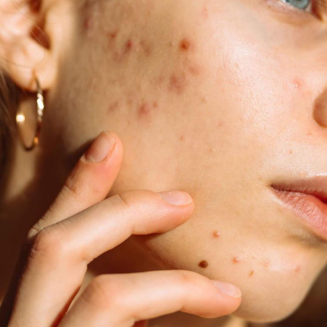 Oily & Acne-Prone Skin