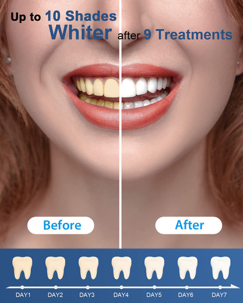 MySmile Teeth Whitening Gel Refills Pack, 6 Non-Sensitive Tooth Whitening Gel for White Teeth, Teeth Whitener Dental Grade Tooth Stain Remover for Tray, Fast Result Whitening