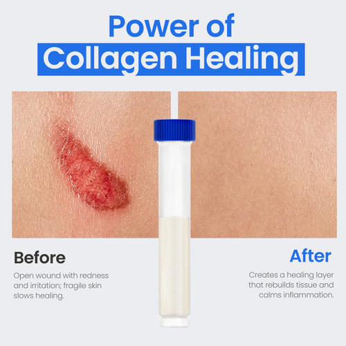 Simpurity Powdered Collagen Wound Dressing - 1g Vials - 5 Count - Medical Grade Bovine Collagen Powder for Wounds, Non-Adherent Collagen Dressing Powder for Chronic and Acute Wound Care