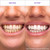 Hismile V34 Whitening Strips, Teeth Whitening Strips, Purple Tooth Whitening, Purple Whitening Strips, Tooth Stain Treatment, Combining Whitening and Colour Correction