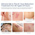 100% Silicone Scar Gel 3-Pack – 3 x 1.06oz Scar Cream for Long-Term Scar Care – C-Section, Surgery, Acne, Keloids, Burns – Fades Old & New Scars Fast