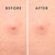 Rael Miracle Microcrystal Spot Cover Hydrocolloid Pimple Patches (36 Ct)
