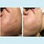 Salicylic 30% Gel Peel - Enhanced with tea tree oil & green tea extract