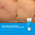 Murad Acne Treatment Trial Kit - 3-pc Set