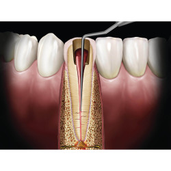 #GP1 SE Root Canal Spreader, Black Line