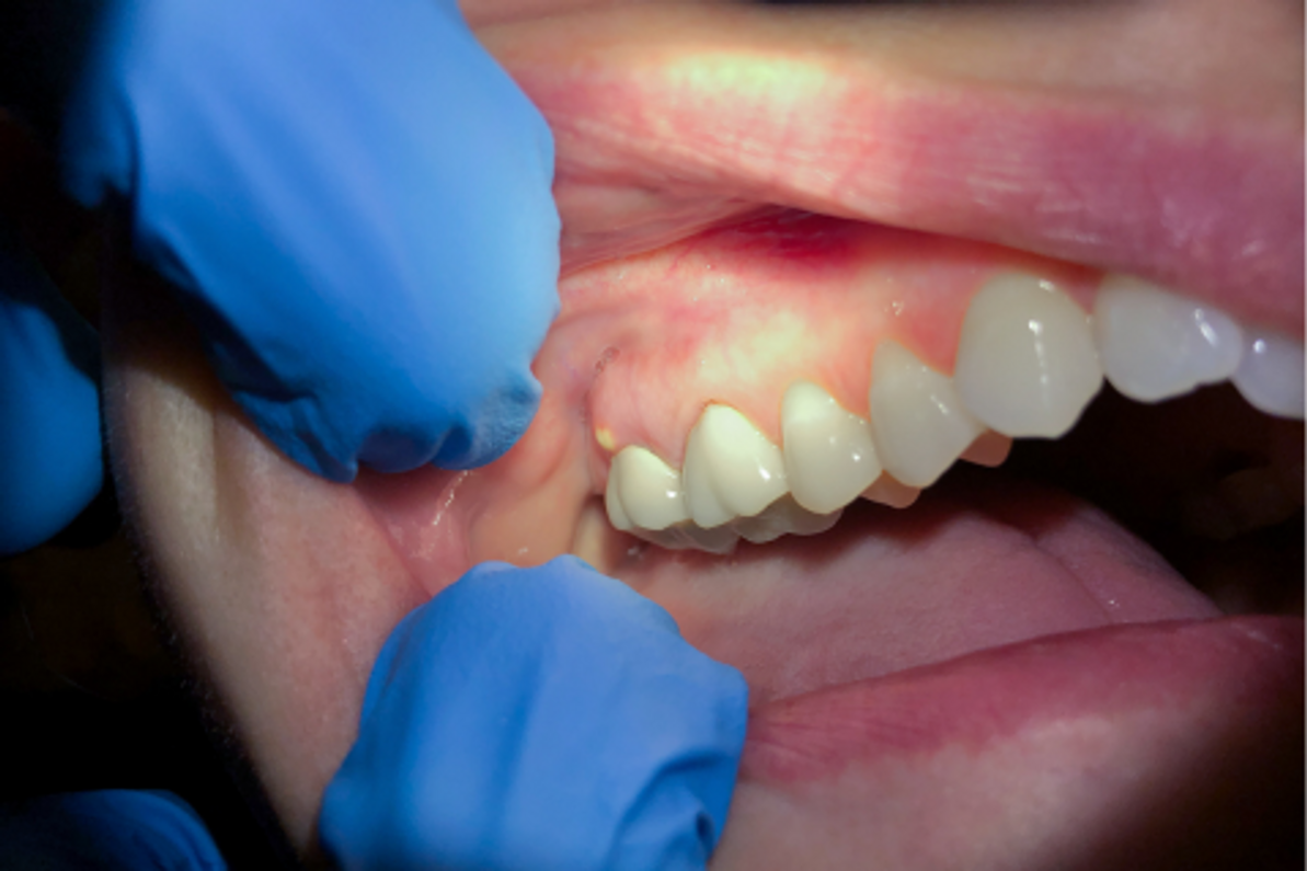 Abcesul gingival: ce este, cum se trateaza, metode de preventie 