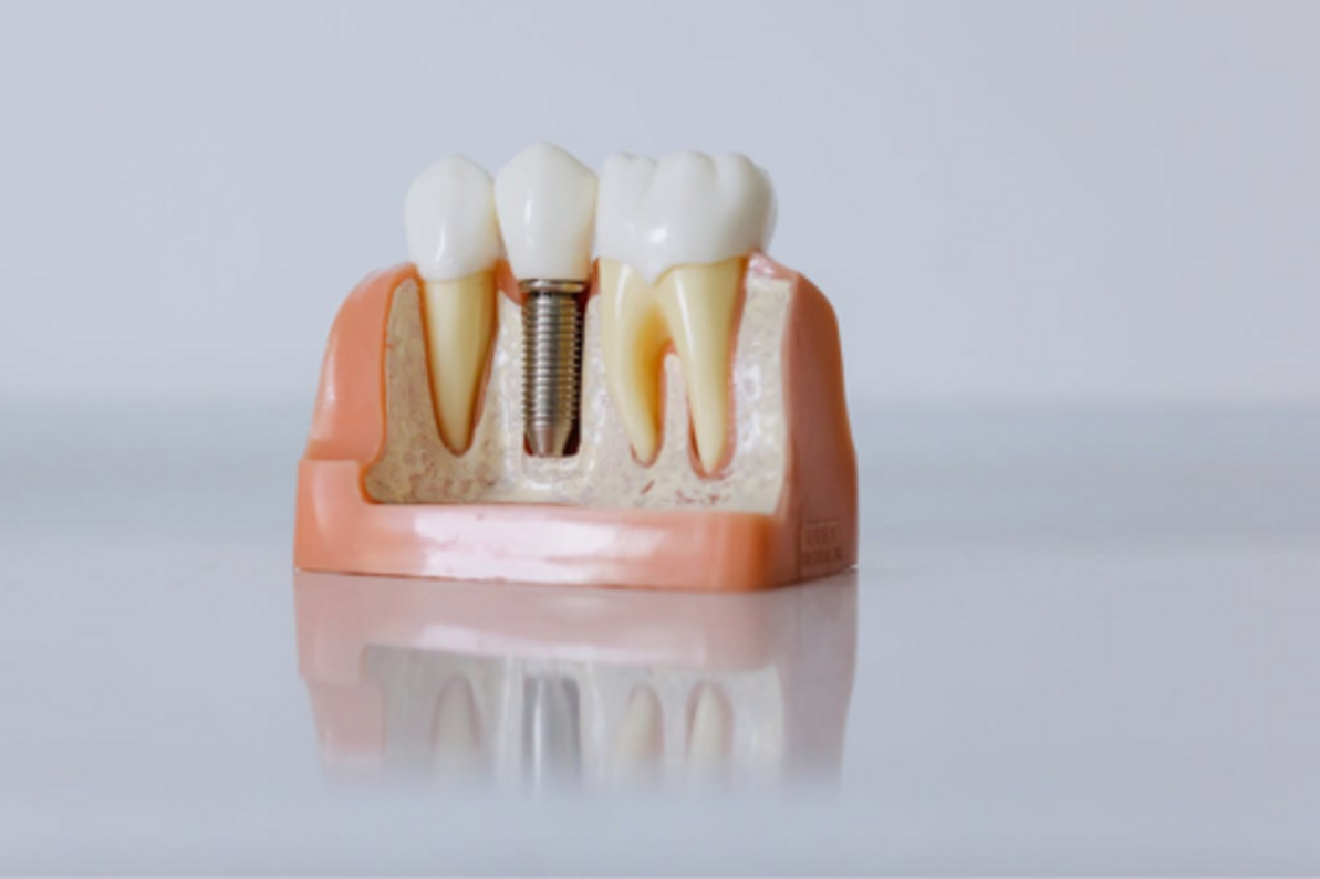 Totul despre implant dentar