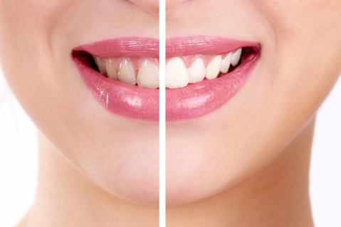 Albirea dentara la domiciliu: cum se foloseste o gutiera pentru albirea dintilor