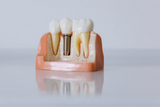 Carii dentare: Ghid complet 