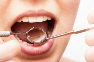 Parodontoza - cauze, simptome, tratament, preventie