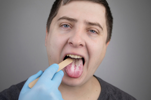 Limba alba: ce este, cauze, afectiuni, tratament