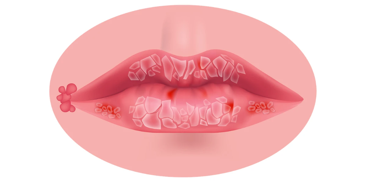 Cheilita angulară sau stomatita angulară este cunoscută sub numele popular de „zăbăluță”