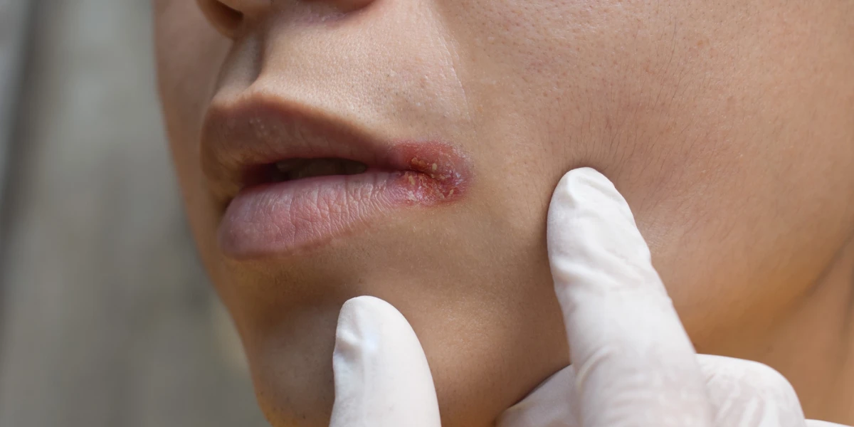 Simptomele cheilitei angulare sunt localizate strict la nivelul comisurilor bucale (colțurile gurii)