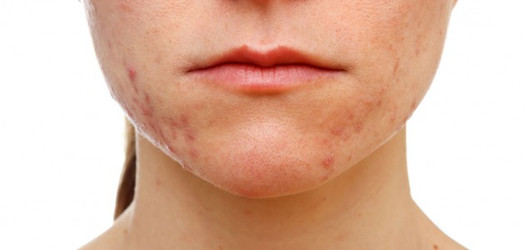  What is Acne And How to Treat It