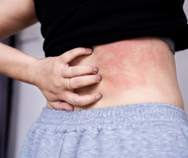 Lyme Disease