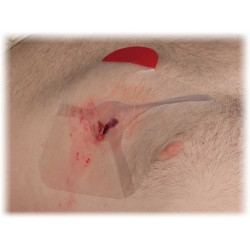 Chest Seal Hyfin® Vent 6 X 6 Inch 2 per Pack NonSterile  (2/PK)