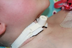 Tracheostomy Tube Collar  (1/EA)