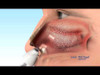 LMA Nasal Mucosal Atomization Device (MAD) - Syringe & Vial Adapter in nose