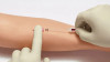 B Braun Introcan Protective IV Catheters in arm