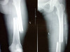 Faretec CT-6 Military Traction Device Splint x-ray