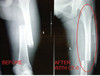 FareTec CT-EMS Bilateral Traction Splint