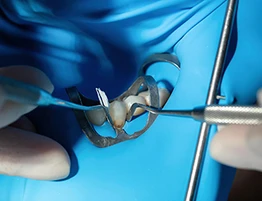 Rubber Dam Isolation: Why Proper Isolation Still Matters in Modern Dentistry