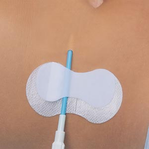 TIDI GRIP-LOK PICC/CVC SECUREMENT DEVICE, 3601CVC