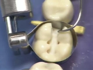 Sectional Matrix Systems: Achieving Predictable Contact Points in Posterior Restorations