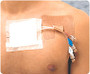 Cath-strip Reclosable Catheter Fastener