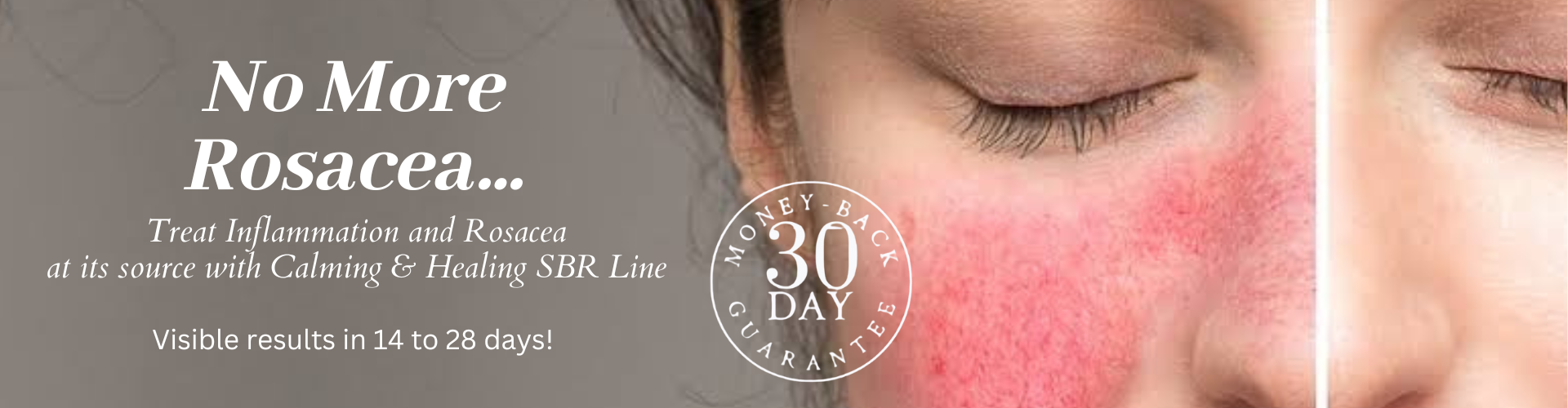 copy-of-new-rosacea-treatment-banner-5.png