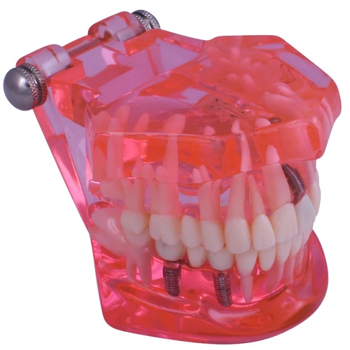 3D Dental Clear Educational Dental Model with Implants (A26C)