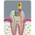 PacDent PacEndo A2 Pac-Taper Thermal Obturator with Plastic Carrier  (TOP-A2)