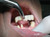 Artcraft TempOff® Crown Remover (TEMPOFF) Artcraft TempOff® Crown Remover (TEMPOFF)
