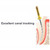 Pac-Dent Pac-File™ Size 20 x 25mm Conform NiTi Rotary File with 0.06 Taper (FFC250620) Pac-Dent Pac-File™ Size 20 x 25mm Conform NiTi Rotary File with 0.06 Taper (FFC250620)