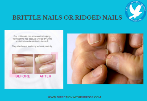 BRITTLE NAILS OR RIDGED NAILS