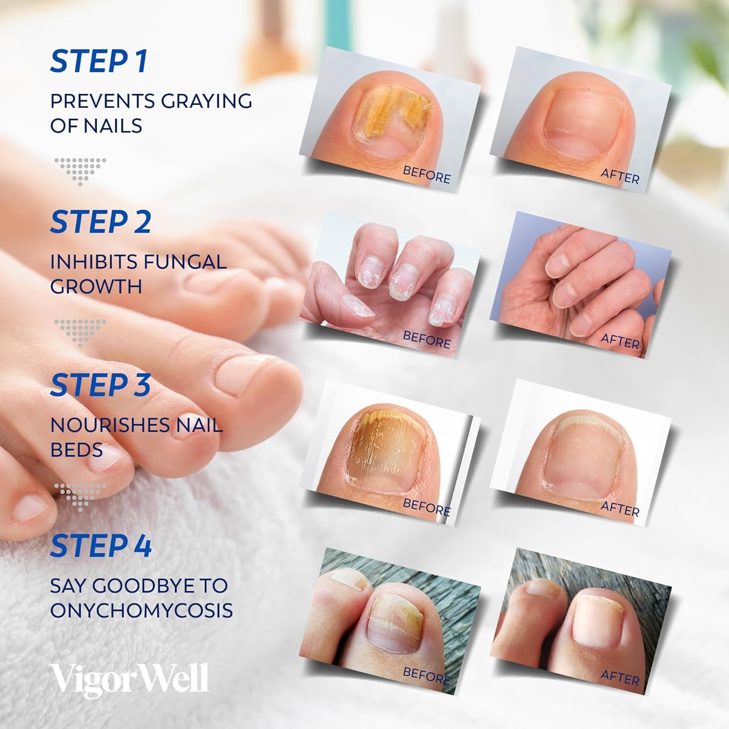 Toenail Fungus Treatment Extra Strength - Nail Fungus Treatment For Toenail Extra Strength - Nighttime Nail Patches & Nail Treatment Liquid Set (32patches+15ml)