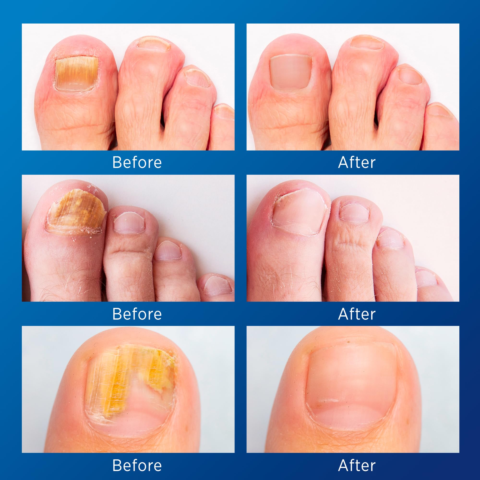 Toenail Fungus Treatment Extra Strength - Nail Fungus Treatment For Toenail Extra Strength - Nighttime Nail Patches & Nail Treatment Liquid Set (32patches+15ml)