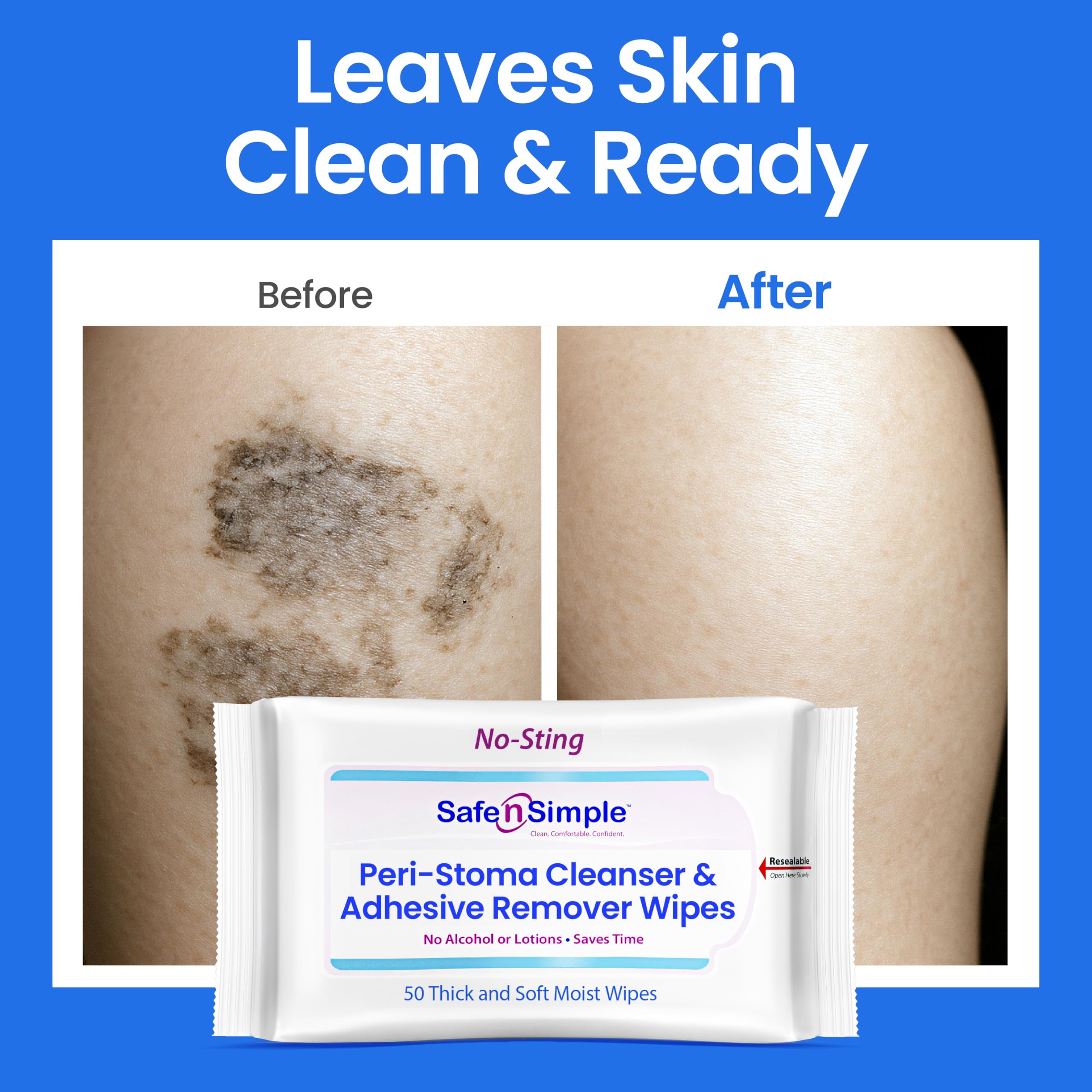 Safe n’ Simple Resealable Adhesive Remover Wipes for Skin - 50 Large 5"x7" No Sting Alcohol Free Medical Adhesive Remover Pads for Ostomy, Stoma Care - Gentle Adhesive Removal Wipes for Bandages, Tape