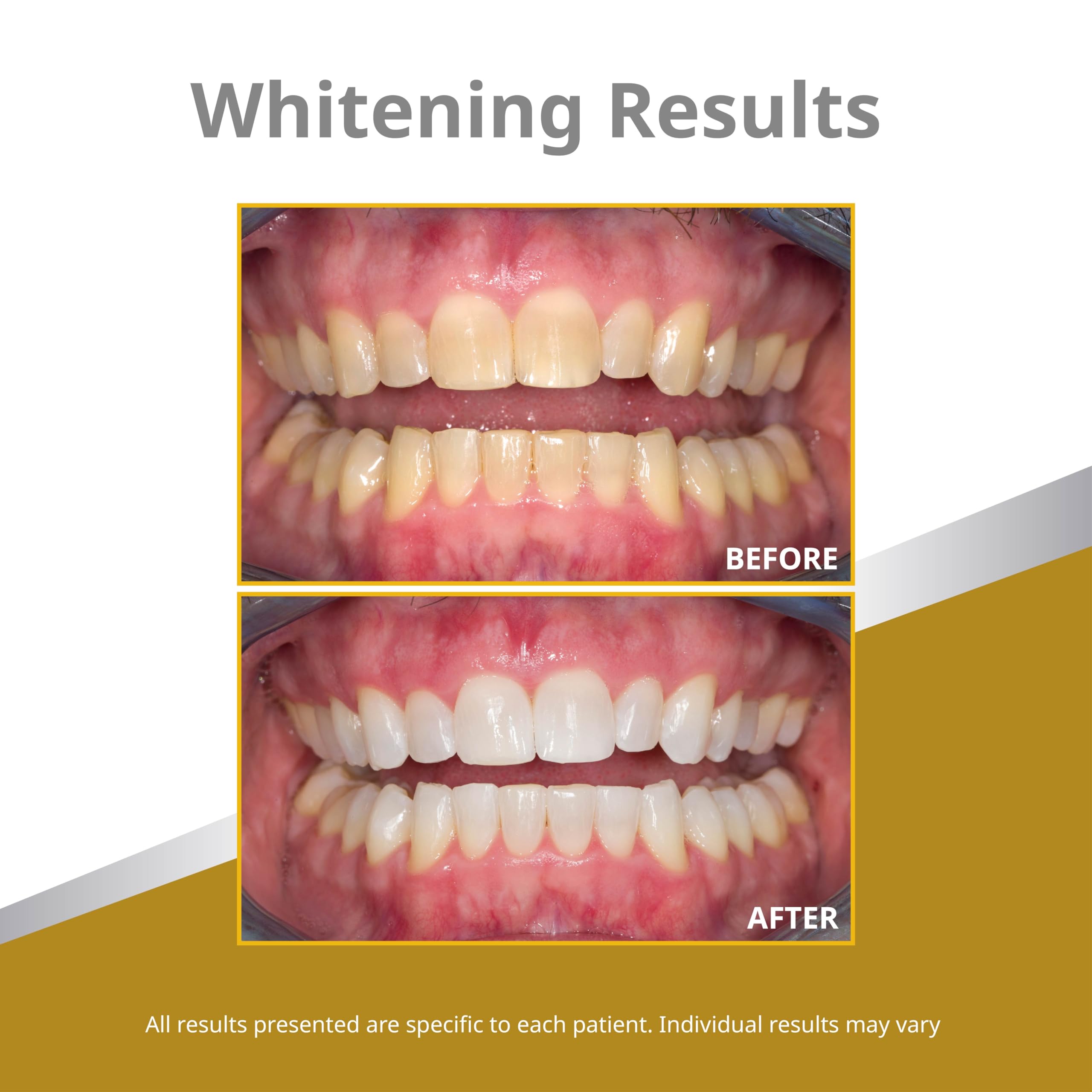 Opalescence 45% Syringes Teeth Whitening Gel - with PF - (8 Syringes) Refill Kit Carbamide Peroxide. Made by Ultradent, in Mint Flavor. Tooth Whitening 5359-4