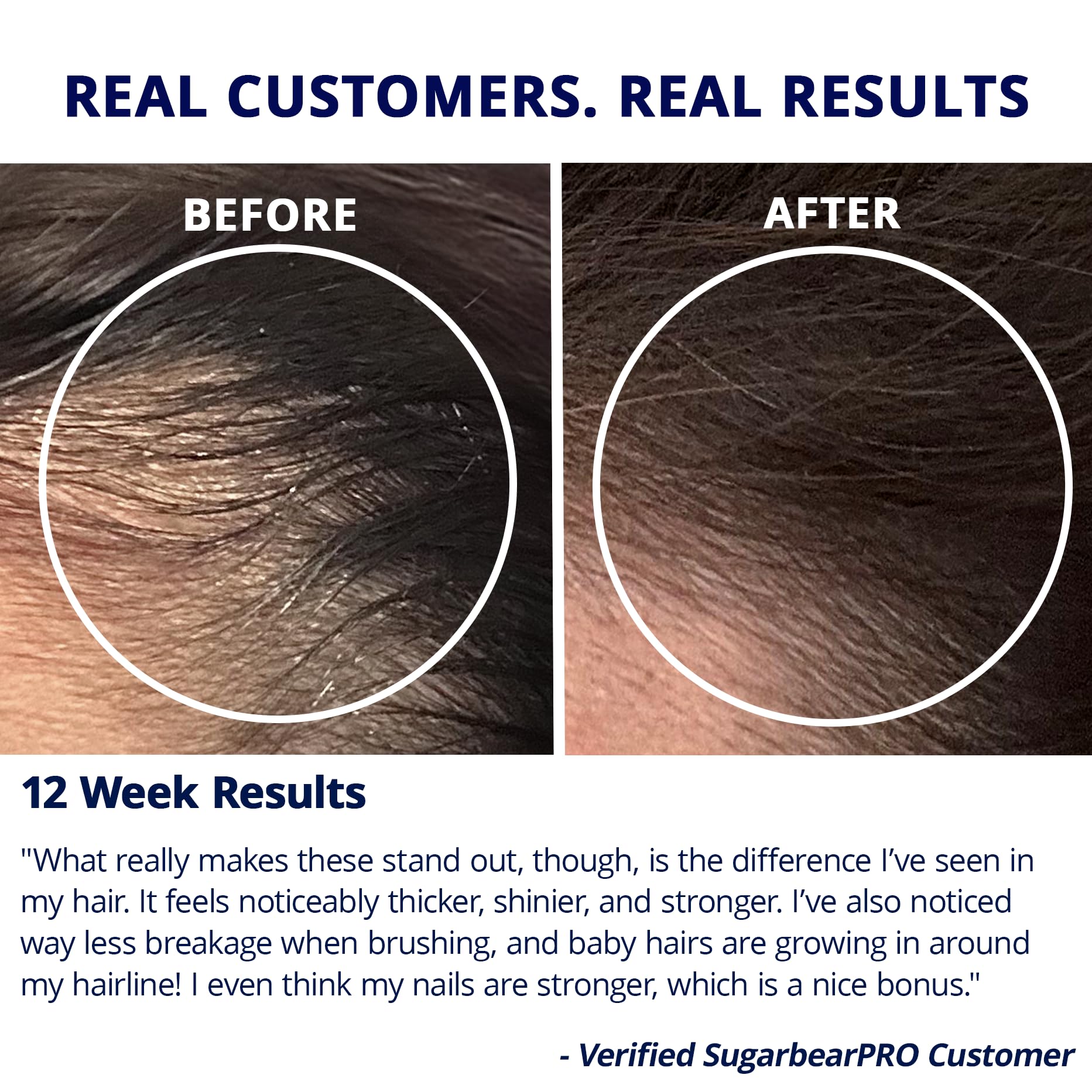 SugarBearPro Hair Vitamin Gummy 3 Month Supply Extra Strength Biotin 6000mcg, Growth for Men & Women, Vegan Vitamin B12, MSM, Inositol, Omega 3, Elderberry, Certified Kosher, Halal, Cruelty-Free